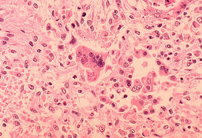 Measles confirmed in 100 Mile House